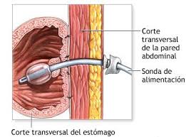 Gastrostomia endoscópica
